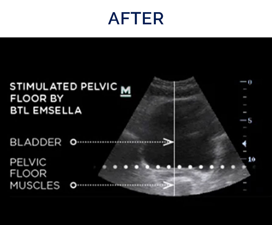 EMSELLA after image | Aesthetics/ Anti-Aging