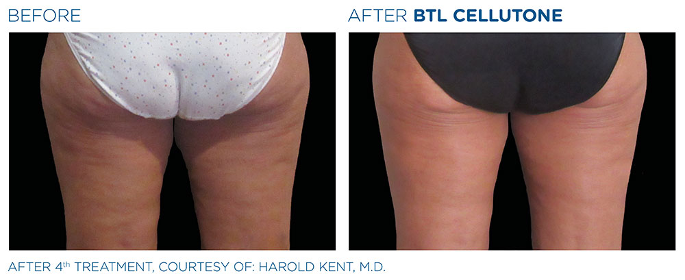 CELLUTONE Before & After | Aesthetics/ Anti-Aging