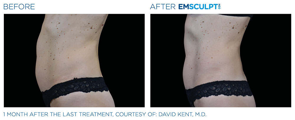 EMSCULPT NEO Before & After | Aesthetics/ Anti-Aging