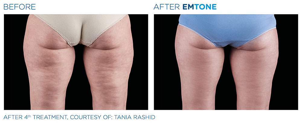 EMTONE Before & After | Aesthetics/ Anti-Aging