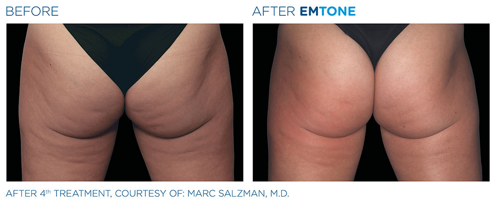 EMTONE Before & After | Aesthetics/ Anti-Aging