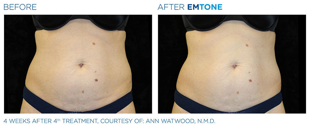 EMTONE Before & After | Aesthetics/ Anti-Aging
