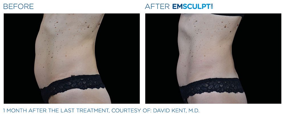 EMSCULPT NEO Before & After | Aesthetics/ Anti-Aging
