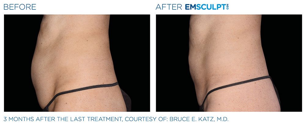 EMSCULPT NEO Before & After | Aesthetics/ Anti-Aging