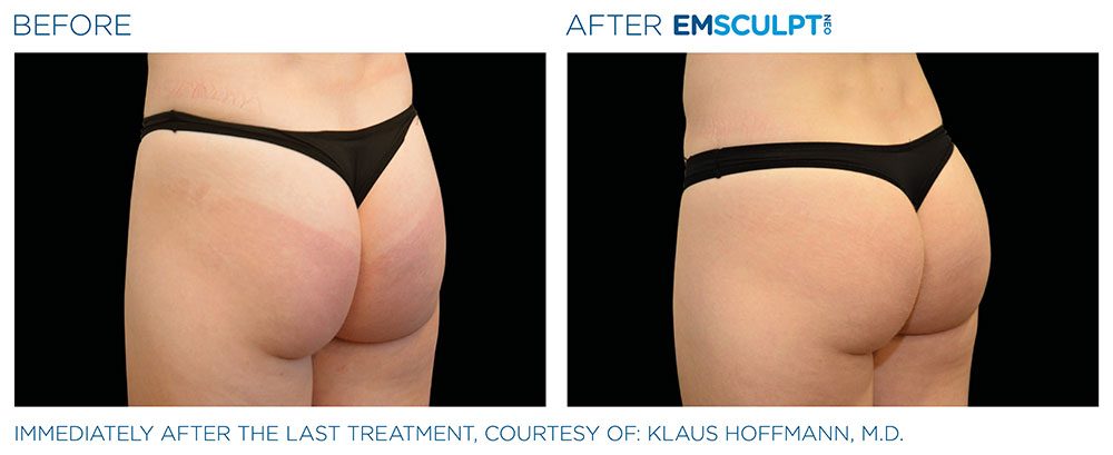 EMSCULPT NEO Before & After | Aesthetics/ Anti-Aging